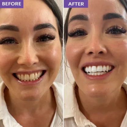 LumiViolet™ - Instant Teeth Brightening Strips - 1 pack (7strips)